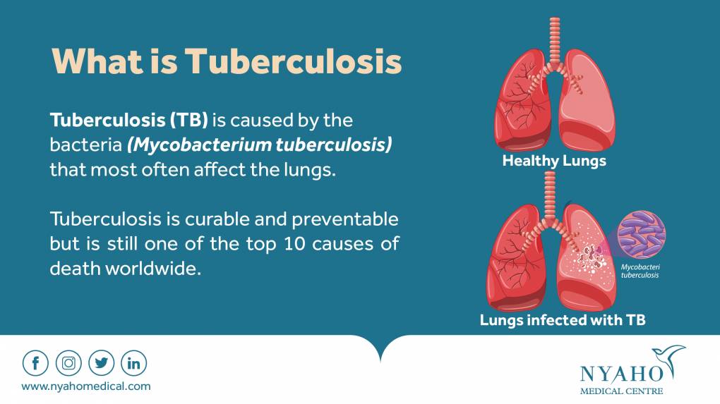 TUberculosis 01 ac906c43d26b8ce742dfa47f9358213b